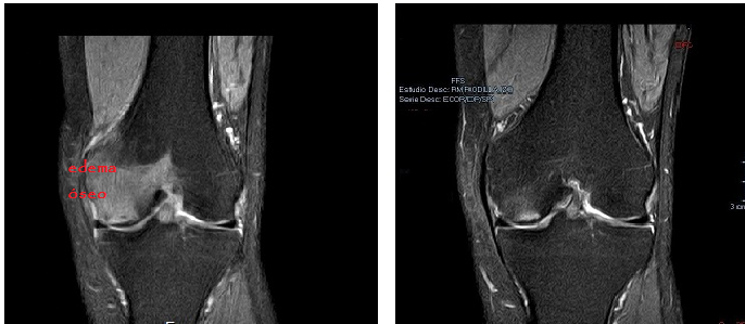 Asunto Que Es Edema Oseo Vertebral Último Asunto Que Es Edema Oseo Vertebral Último