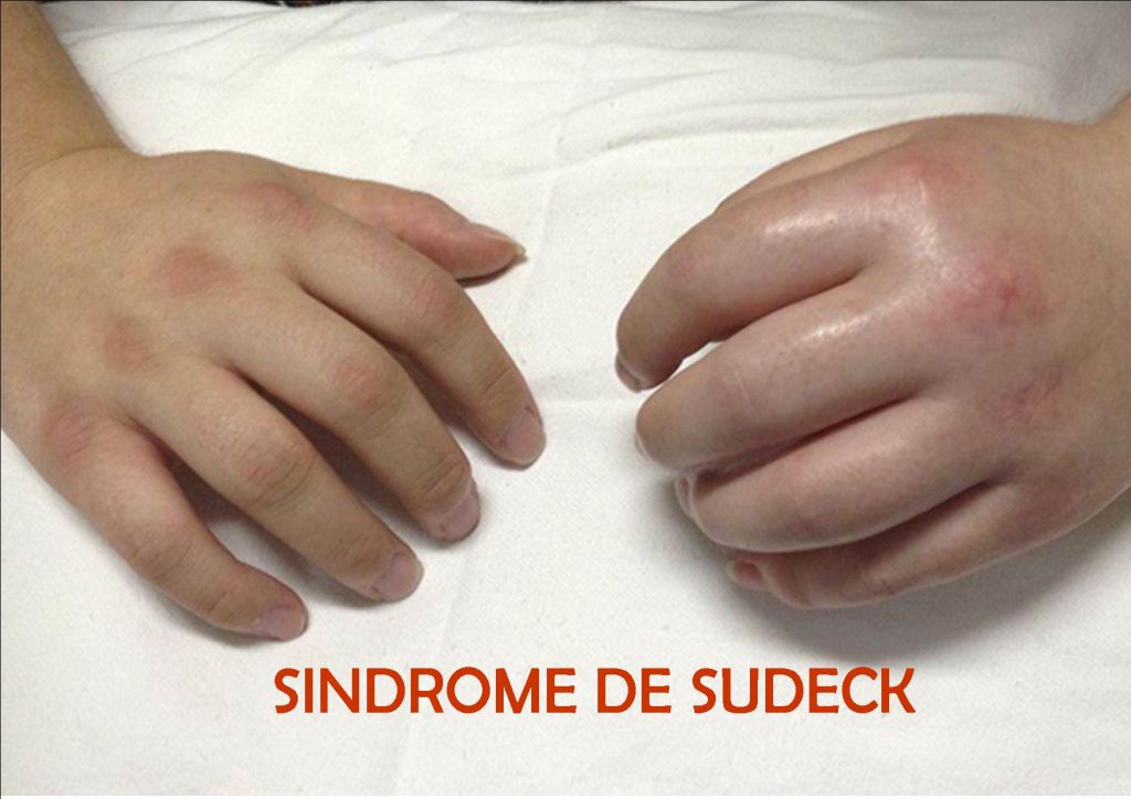 sudecck2 1