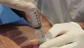 hidrodilatacion