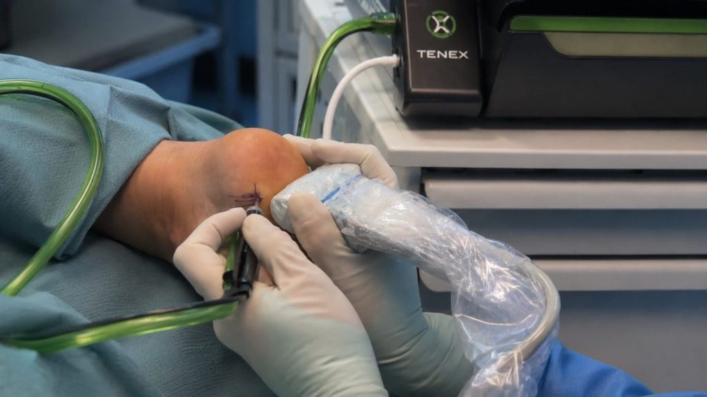 terapia tenex